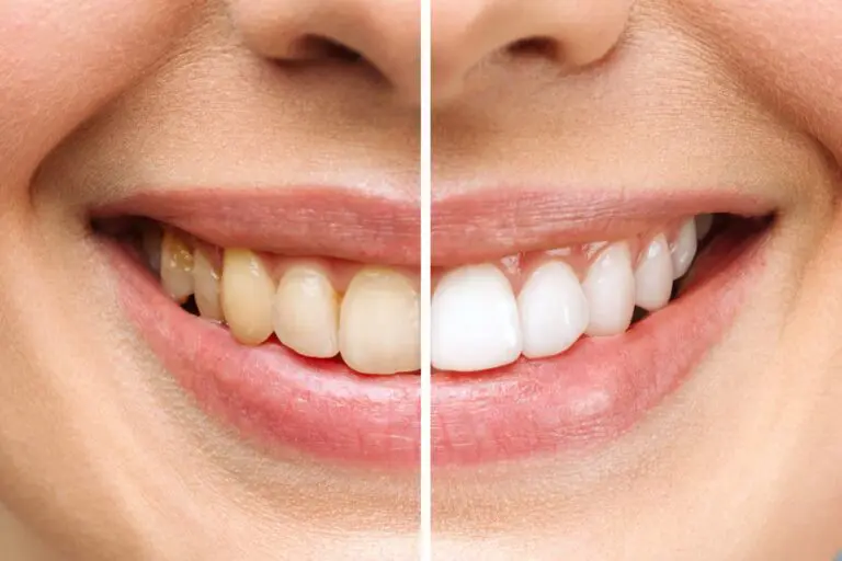 A smile comparison with stained teeth on the left and whiter teeth on the right, after BeSpoke Orthodontics in Burtonsville, MD.