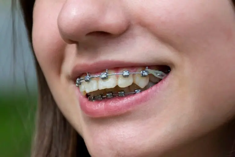 Close-up of a smiling girl with traditional metal braces on her teeth – How to Fix Overbite in Burtonsville, MD.
