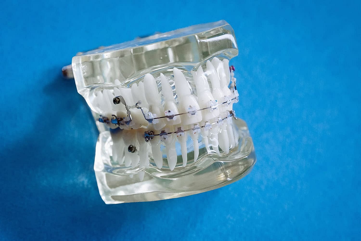 Displayed on a blue surface, a dental model with metal braces and wires represents BeSpoke Orthodontics in Burtonsville, MD.