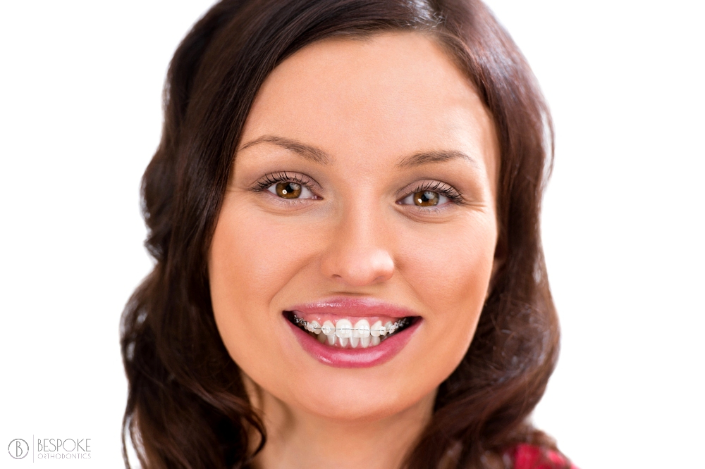 woman wearing orthodontic ceramic clear braces - Overbite vs Underbite in Burtonsville, MD